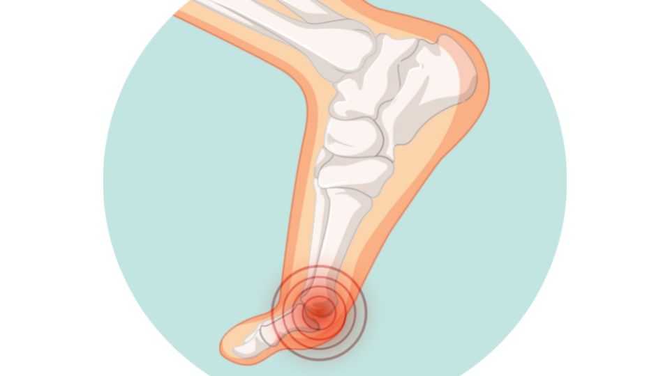 Halluks Valgus görseli - DrCem hastalık rehberi